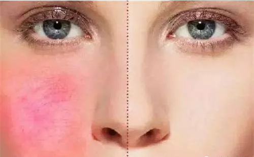 激素臉紅血絲癥狀為什么那么難修復(fù)