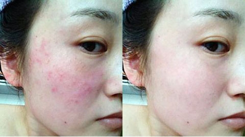 過敏肌膚怎么修復最快？