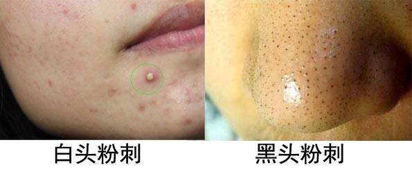 什么是痤瘡，什么是粉刺？痤瘡和粉刺有啥區別？