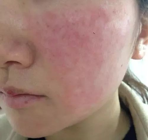 紅血絲的種類有哪些？