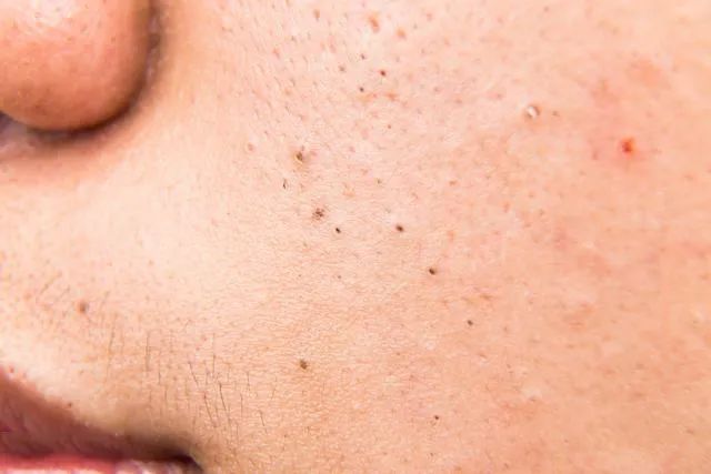 黑頭是怎么形成的？如何預防黑頭的產生？