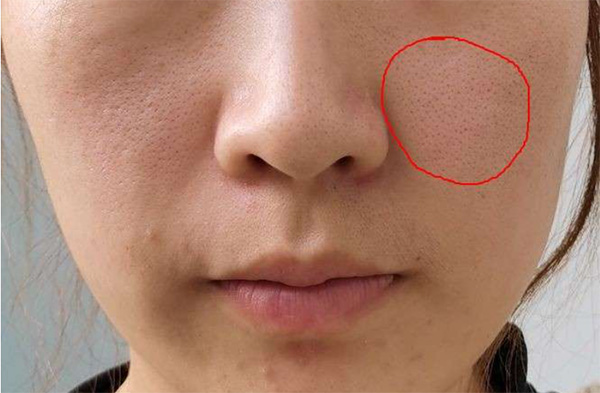毛孔粗大如何預(yù)防？毛孔粗大預(yù)防措施