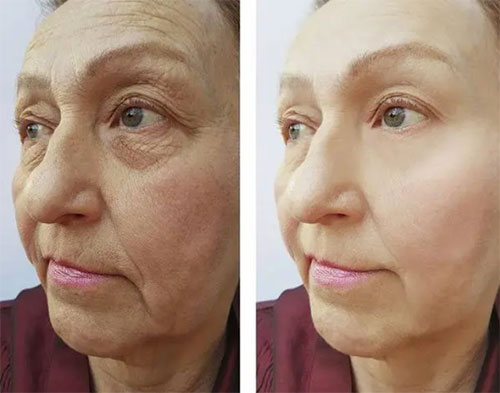 臉部松弛下垂如何改善？面部松弛下垂改善方法！