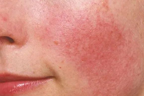 換季皮膚過敏怎么辦？換季皮膚過敏的解決辦法！